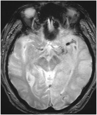 Case report: Utilization and efficacy of large-bore catheters in mechanical thrombectomies